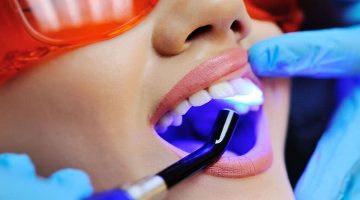 Diş Dolgusu Nasıl Yapılır? Diş Dolgusu Nasıl Yapılır?