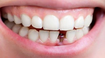 Diş İmplantı Nasıl Yapılır? Diş İmplantı Nasıl Yapılır?